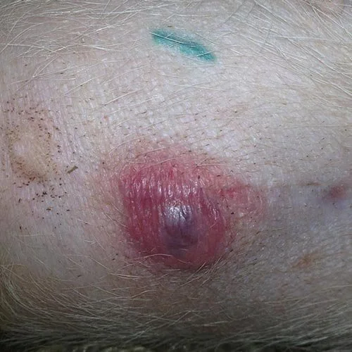 infected spay incision