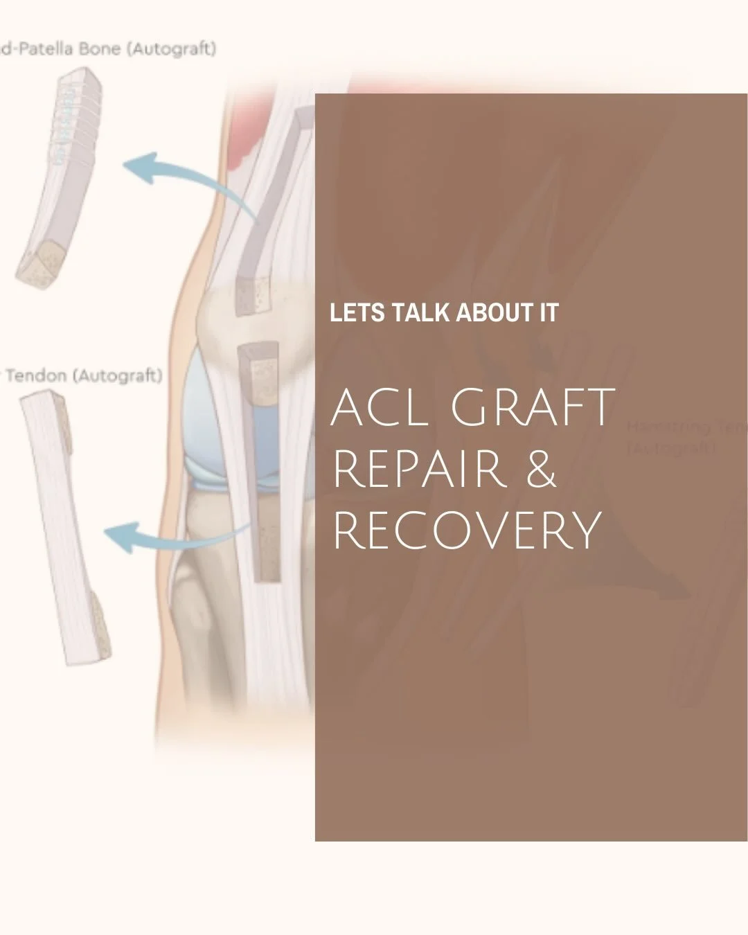 Let&rsquo;s Talk About: ACL Graft Repair &amp; Recovery 🦵