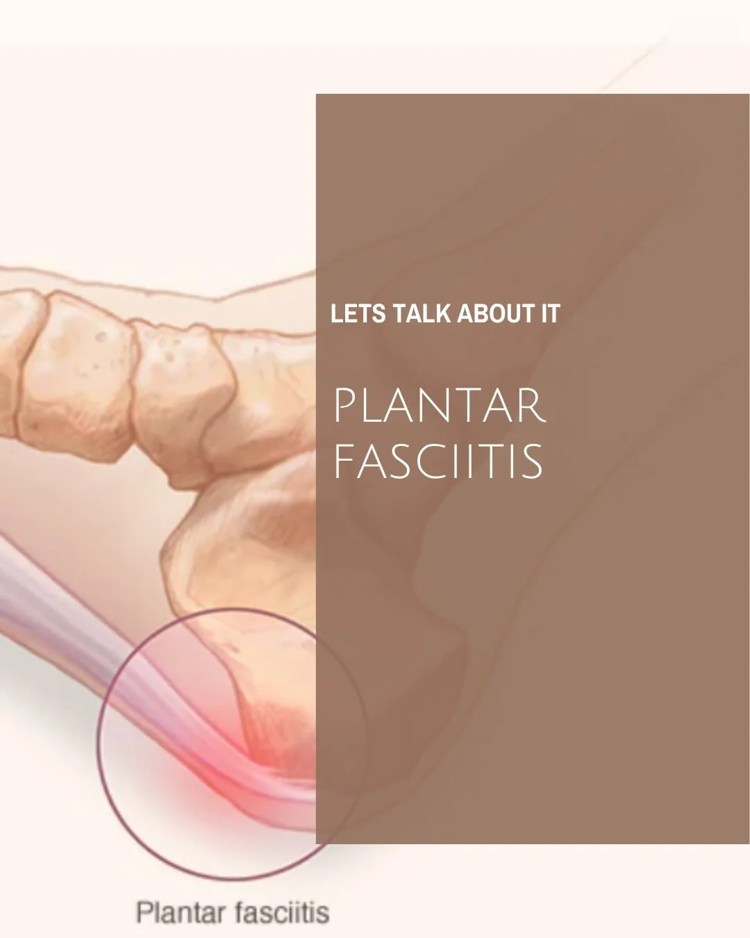 Let&rsquo;s Talk About: Plantar Fasciitis ✨🦶