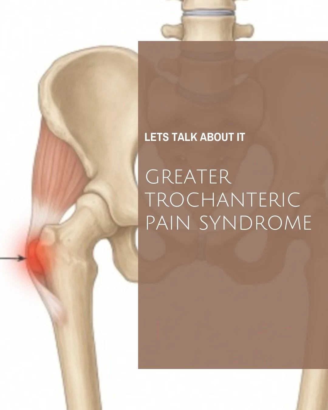 Let&rsquo;s Talk About: Greater Trochanteric Pain Syndrome ✨