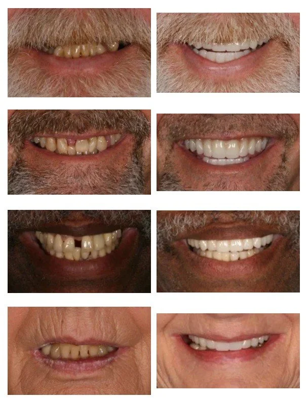 Comparison of dental health before and after dental treatments across multiple individuals, showing improved teeth alignment and whiteness.