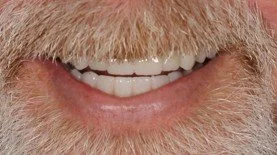 Close-up of a smiling person's mouth showing white teeth and a beard and mustache.