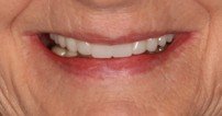 Close-up of a smiling person's mouth showing white teeth and pink lips.