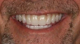 Close-up of a smiling person's mouth showing white teeth.