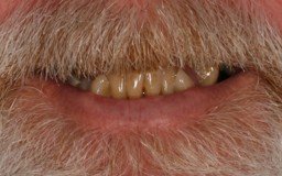 Close-up of a person's mouth showing crooked, discolored teeth with some missing.