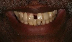 Close-up of a person's smile showing several yellowed and uneven teeth.