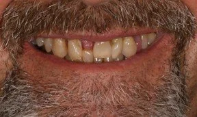 Close-up of a person's mouth showing discolored and misaligned teeth with some missing