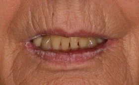 Close-up of a person's mouth showing discolored, damaged teeth and uneven lips.
