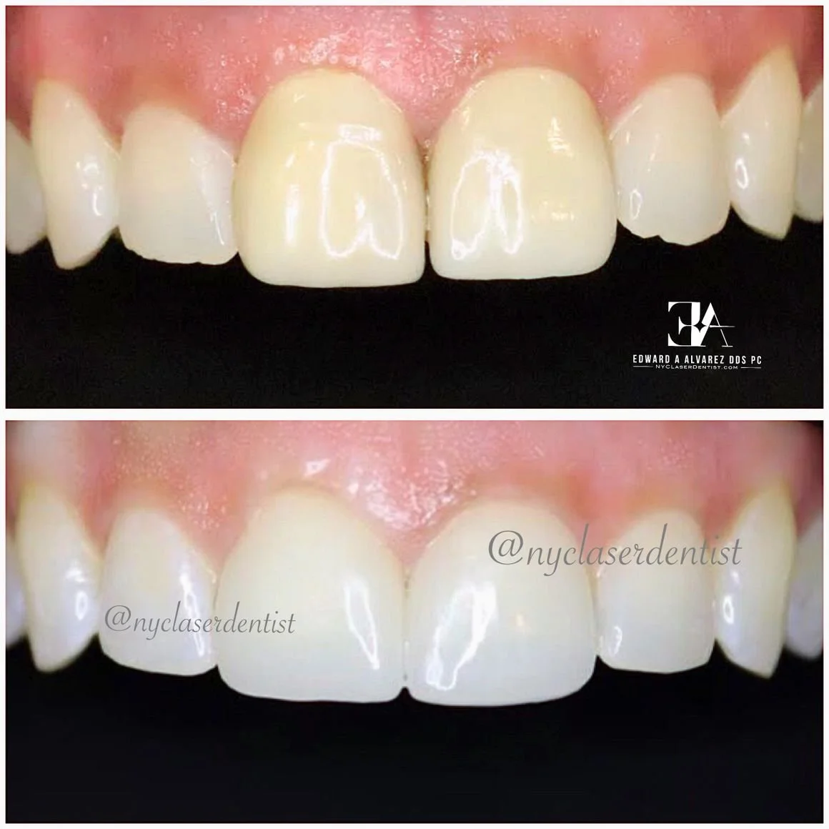 Before and after dental veneers showing improved teeth alignment and color  done by Dr. Edward Alvarez Cosmetic Dentist