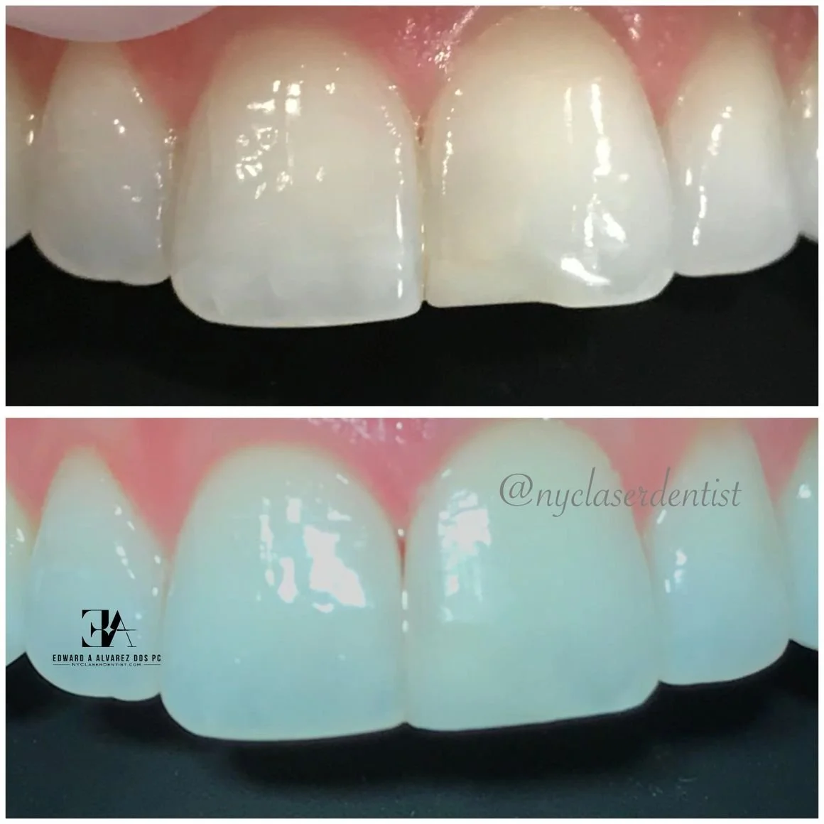Close-up of two images showing teeth before and after dental treatment, highlighting improvements in tooth color and alignment  done by Dr. Edward Alvarez Cosmetic Dentist