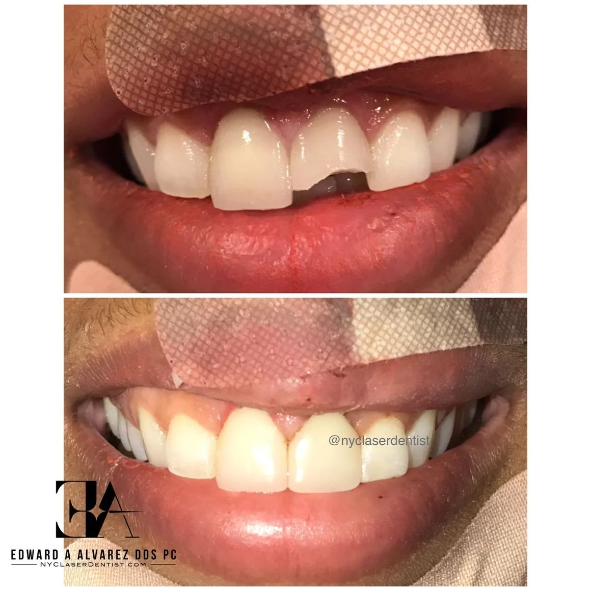 Before and after dental treatment showing chipped tooth repair done with a cerec veneer  done by Dr. Edward Alvarez Cosmetic Dentist