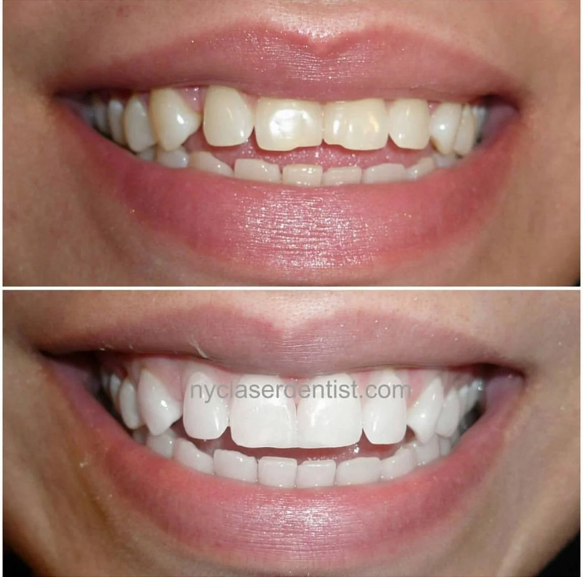 Before and after dental treatment showing smile improvements, featuring whiter and more aligned teeth  done by Dr. Edward Alvarez Cosmetic Dentist