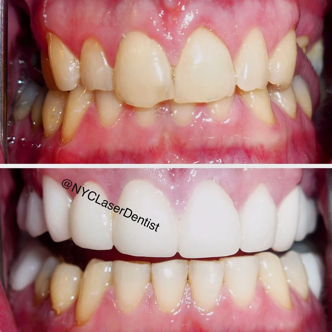 Before and after dental treatment showing teeth whitening and alignment correction with cerec veneers  done by Dr. Edward Alvarez Cosmetic Dentist