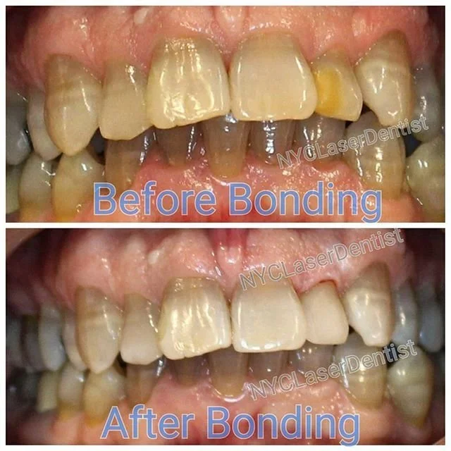 Close-up dental images showing teeth before and after cosmetic bonding. The "Before Bonding" image displays discolored and uneven teeth, while the "After Bonding" image shows improved teeth color and alignment. "NYCLaserDentist" text watermark is pre
