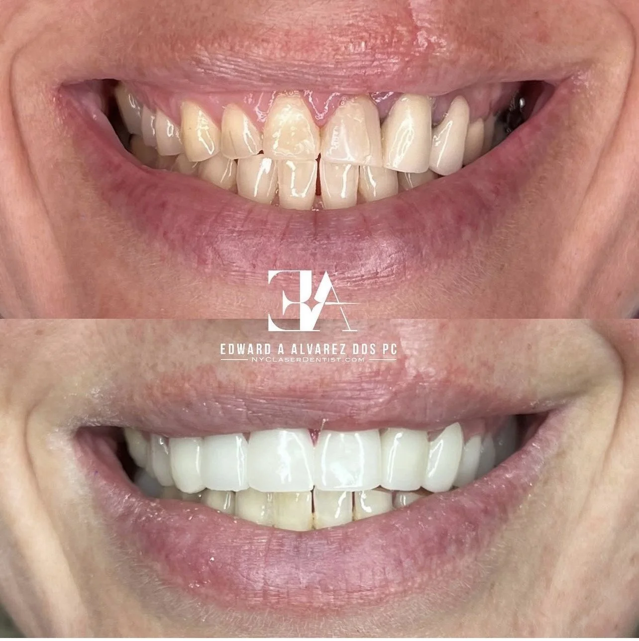 Before and after dental treatment showing improved teeth appearance, with the top image displaying natural teeth and the bottom image showing a whiter and more aligned smile. Branding of a dental office visible of Edward A Alvarez DDS PC