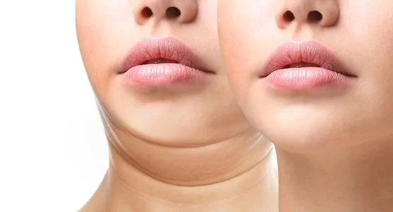 Image of a woman with and without a double chin