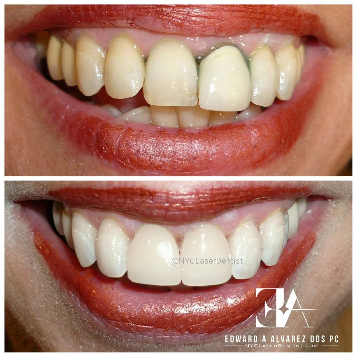 Before and after dental treatment showing improved teeth alignment, color, and appearance  done by Dr. Edward Alvarez Cosmetic Dentist
