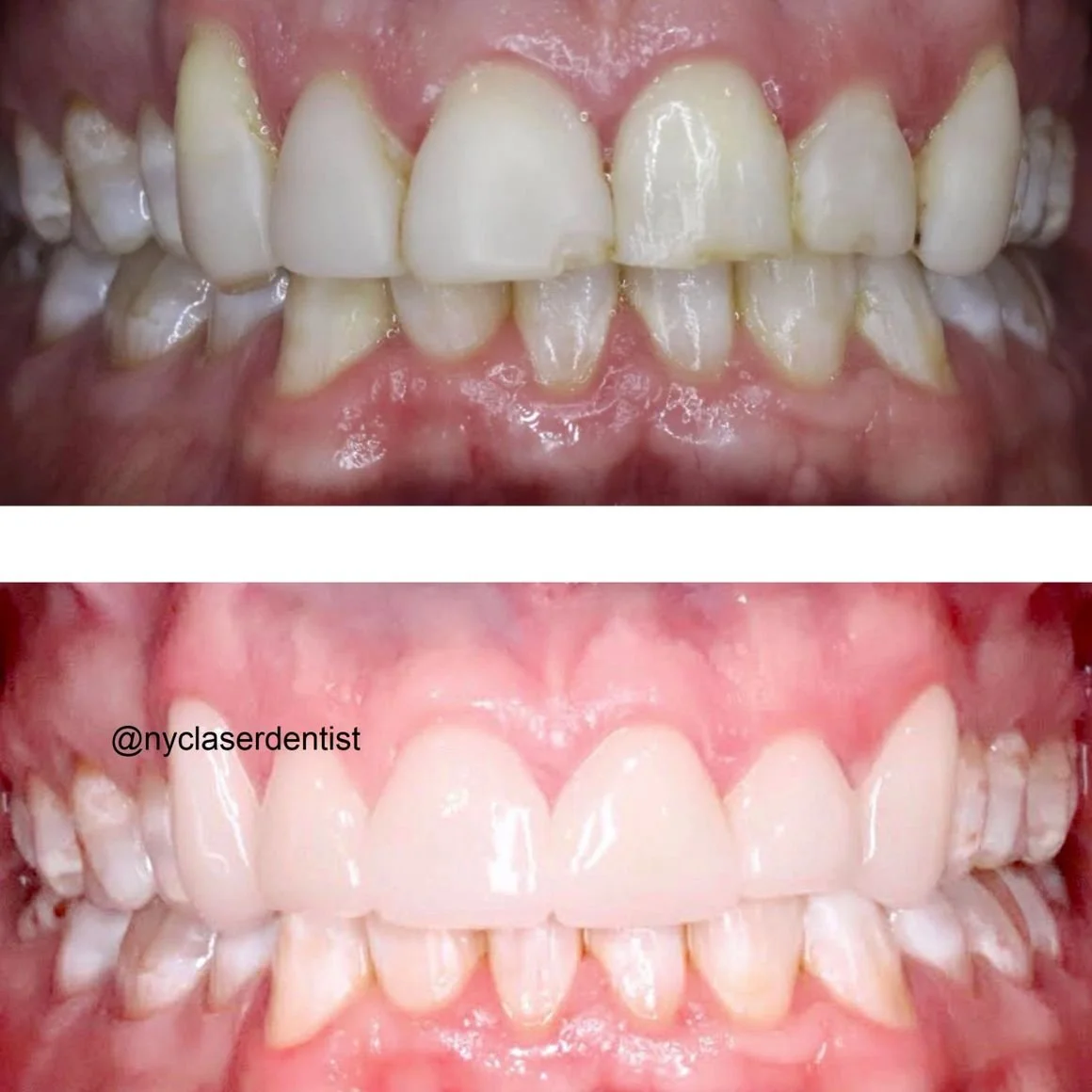 Close-up of teeth showing a dental transformation, with before and after images highlighting improved tooth alignment, Cerec crowns, and whitening  done by Dr. Edward Alvarez Cosmetic Dentist