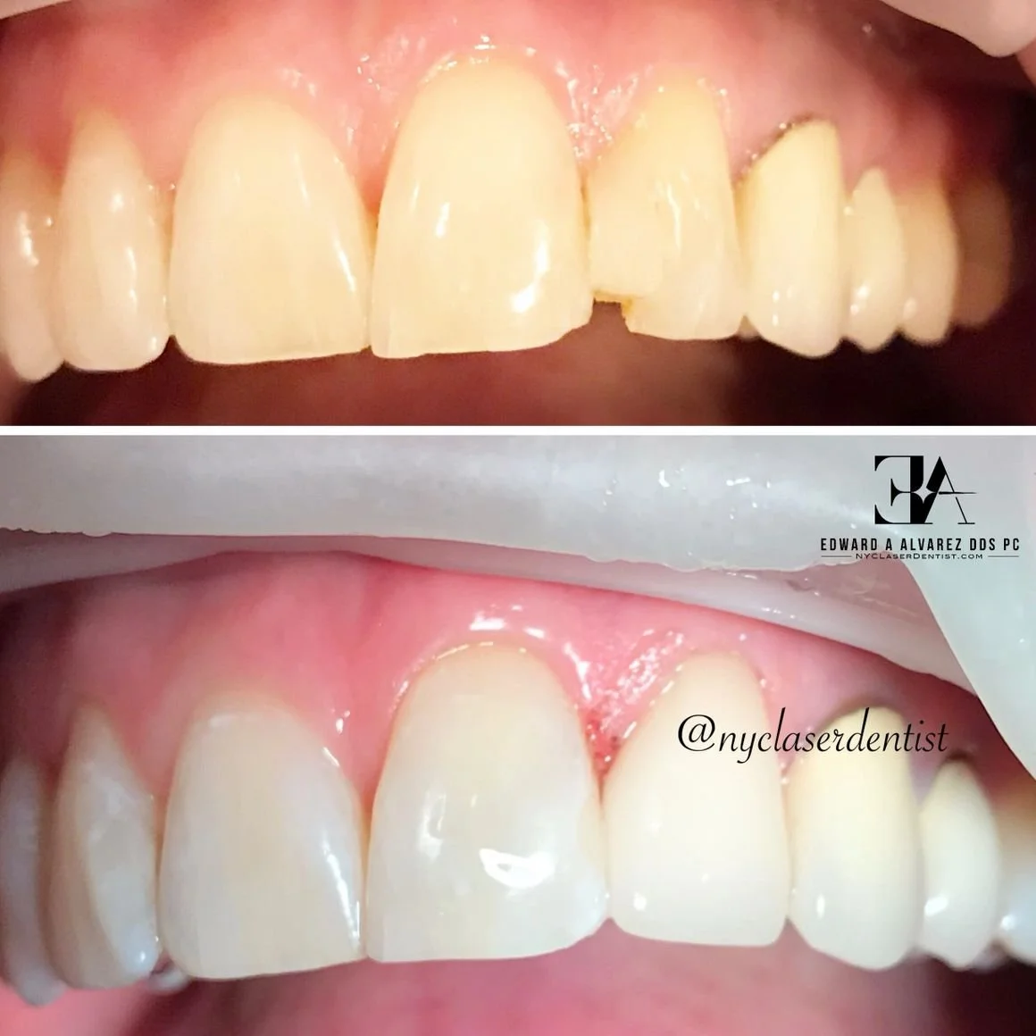 Before and after dental treatment showing teeth whitening and alignment improvements  done by Dr. Edward Alvarez Cosmetic Dentist