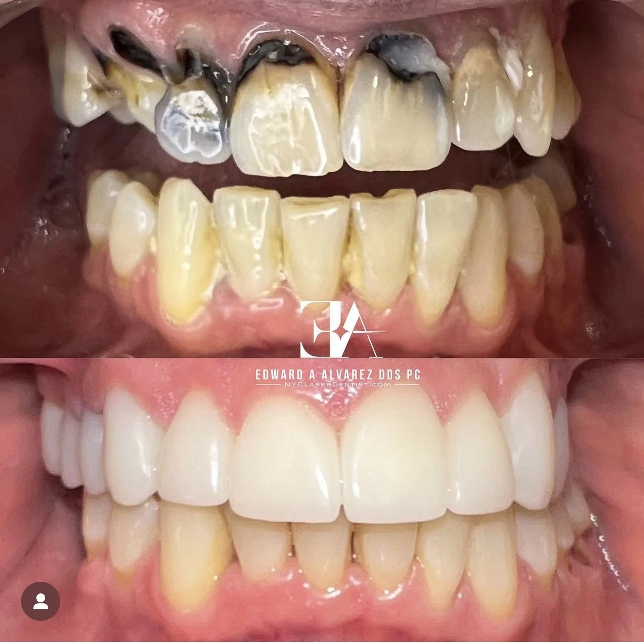 Before and after dental treatment showing cavities and decayed teeth replaced with healthy, white teeth done at Edward A Alvarez DDS PC NYCLaserDentist