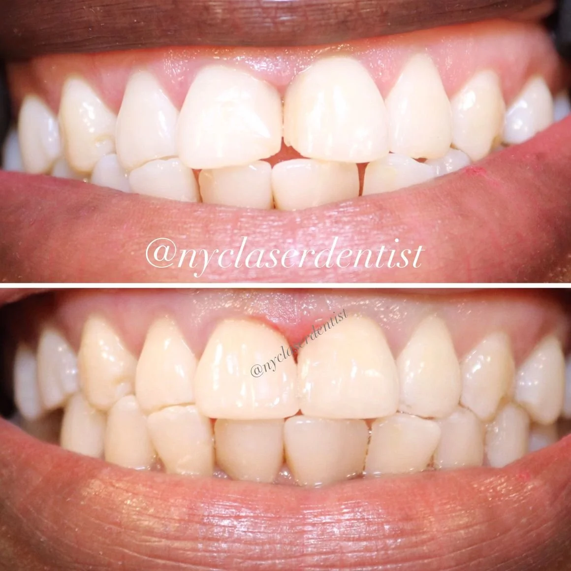Before and after dental treatment showing improved tooth alignment and color  done by Dr. Edward Alvarez Cosmetic Dentist