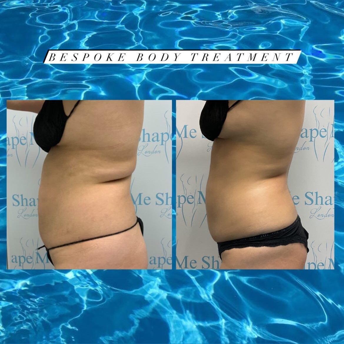 The talk of the town 😍✨

This beautiful doll came to us once a week for a package of 10! She felt she had gained weight and retained water after having her new baby.
Just look at these beautiful results we were able to achieve the natural way!
💧No 
