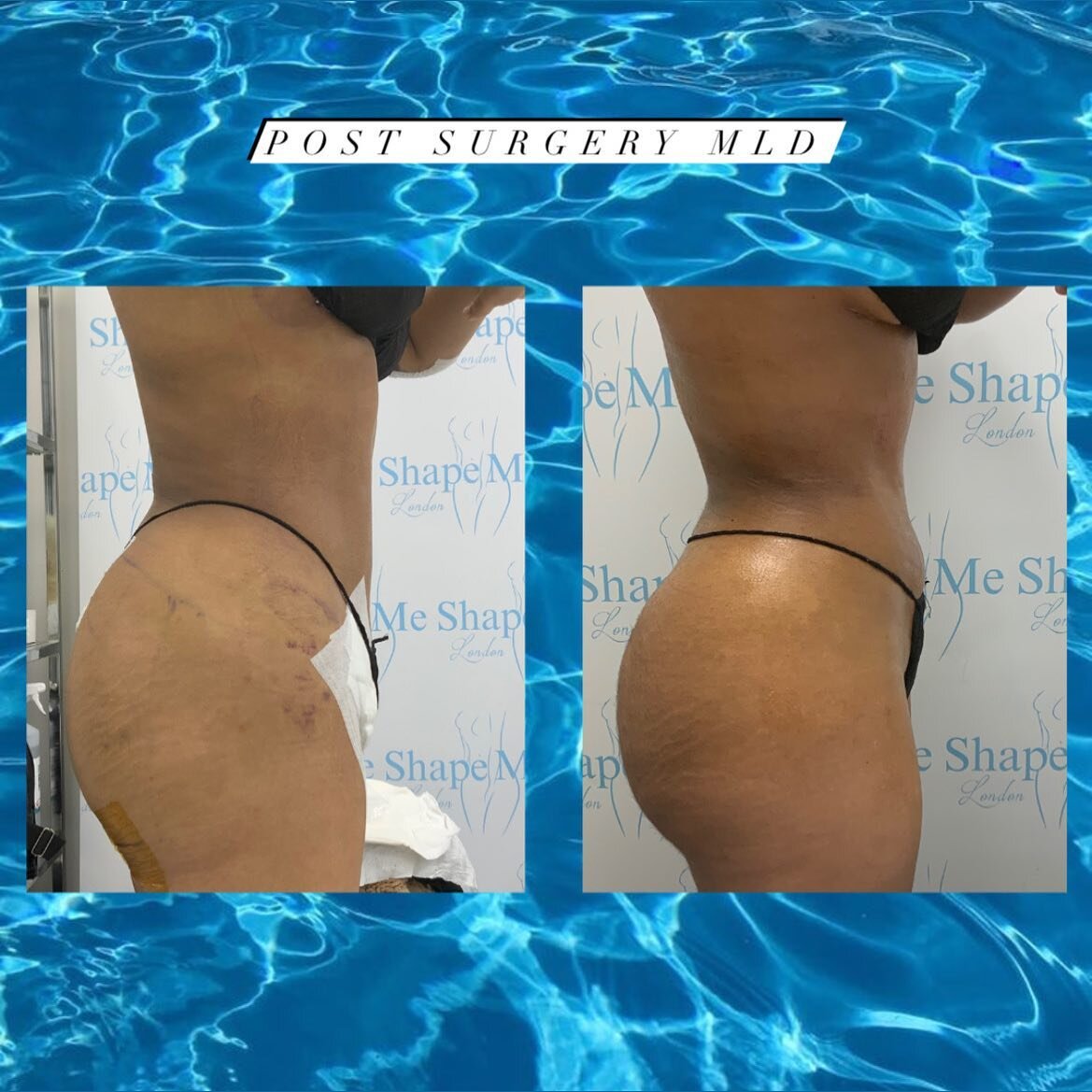 Swollen sally to Healed hunny 😍

Post cosmetic surgery specialists at your service ✨
We pride ourselves in providing the best techniques for PAIN FREE post op lymphatic drainage that not only reduces your swelling, speeds up your recovery but also s