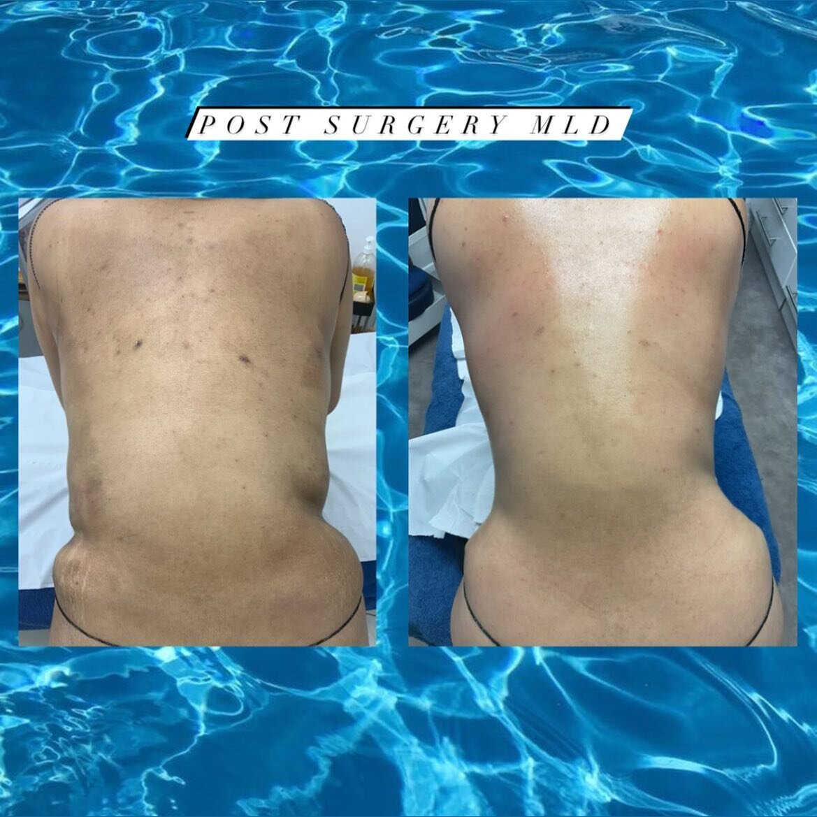 Post cosmetic surgery specialists ✨

This angel came to us 2 weeks post tummy tuck and 360 lipo extremely upset with her results from severe swelling and unevenness. 
After a package with us we were able to correct uneven pockets, shape and mould her