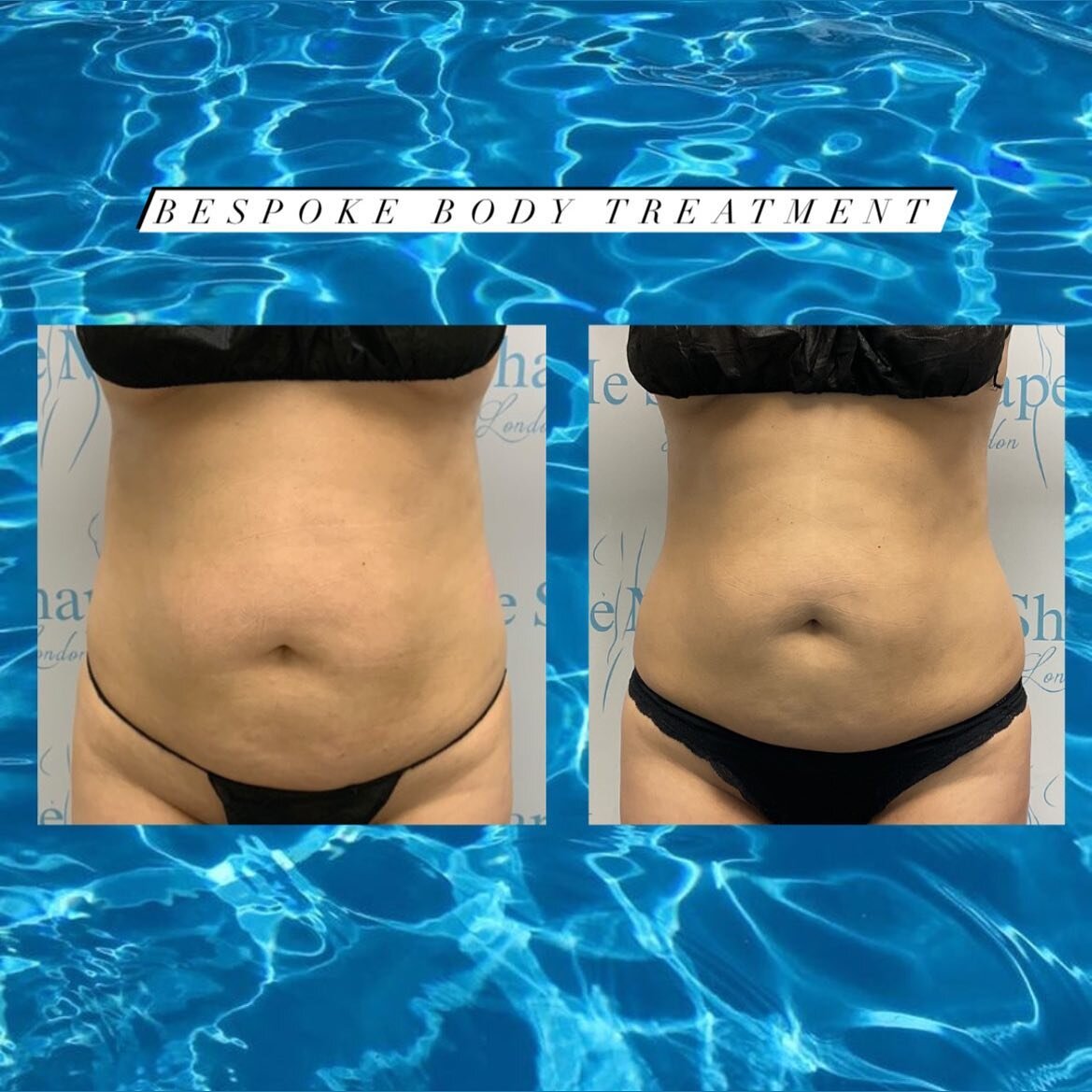 We are so proud of these results 🥹🩵No surgery needed to have our famous bespoke body treatment! 

This beautiful doll came to us after having her first baby feeling full of fluid and stubborn areas.
She came to us once a week for a package of 10 an