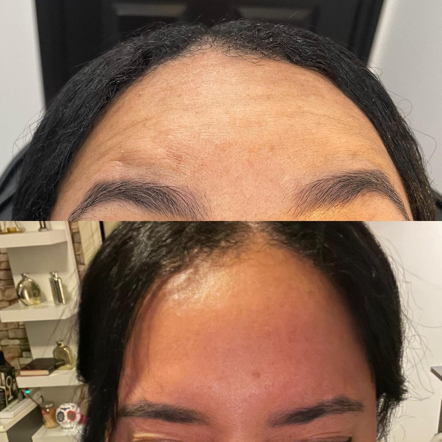Beautiful subtle Botox results. 💉✨

Have you booked with us yet? 

Book online now 

Or call us! 
&hellip;&hellip;&hellip;&hellip;&hellip;..

Hermosos resultados sutiles de Botox. 💉✨ 

&iquest;Ya reservaste con nosotros? 

Reserve en nuestra pagina