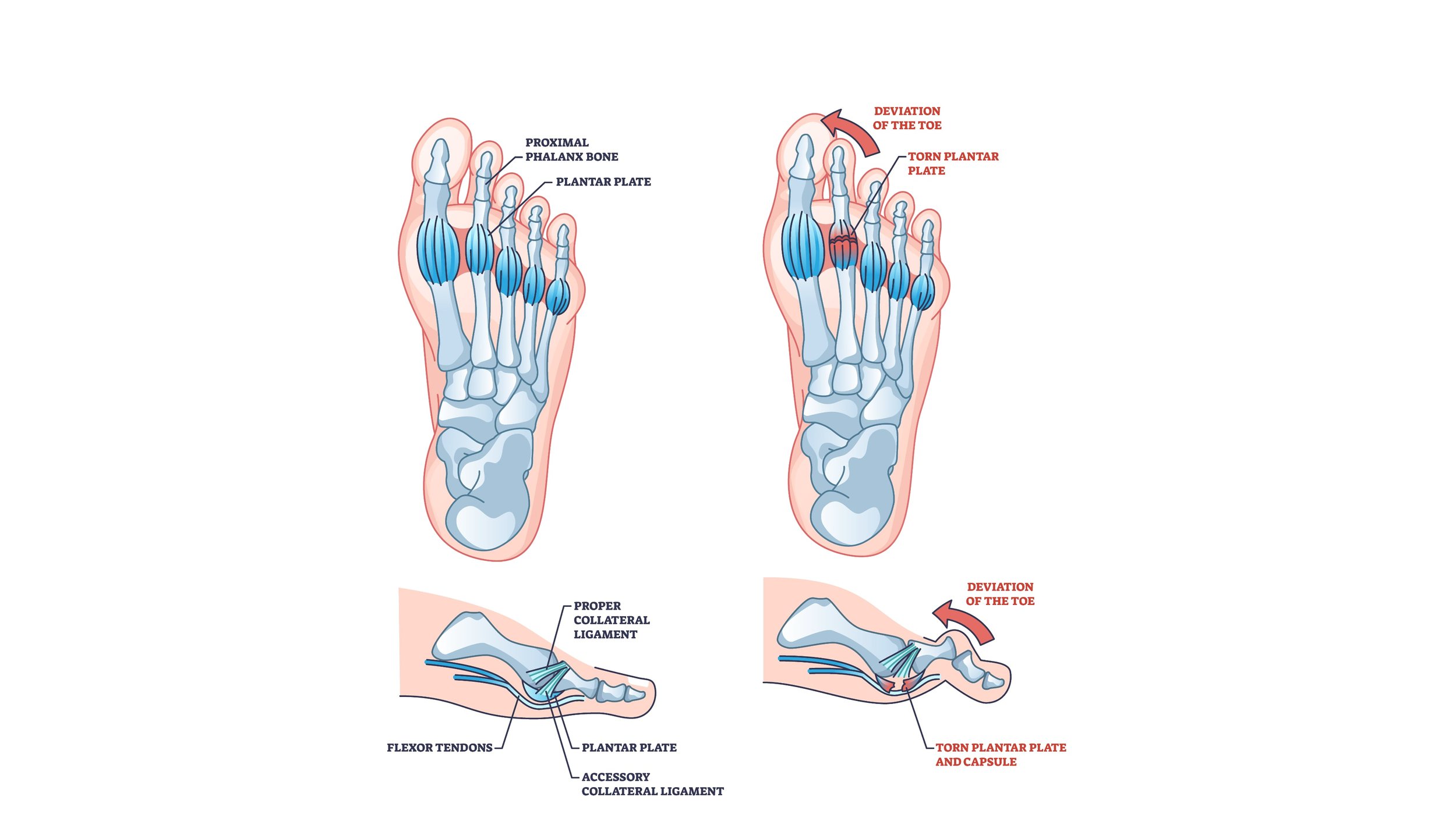 Plantar Plate Injuries: Understanding a Common Cause of Forefoot Pain