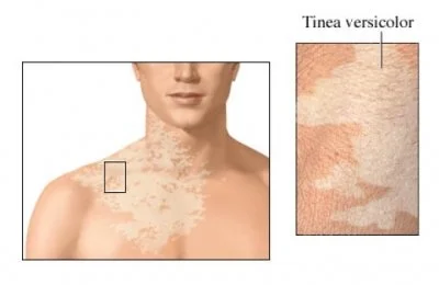 Home remedies and treatments for Tinea versicolor