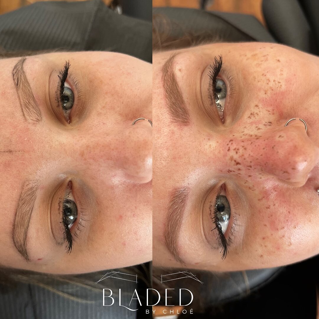Fresh brows and freckles for this gorgeous mama today! ☀️ 
*color lightens by about 25-30%*

Here is a great example of &ldquo;blanching&rdquo;, which is caused by vasoconstriction delivered by the secondary numbing. Temporary blood vessel constructi