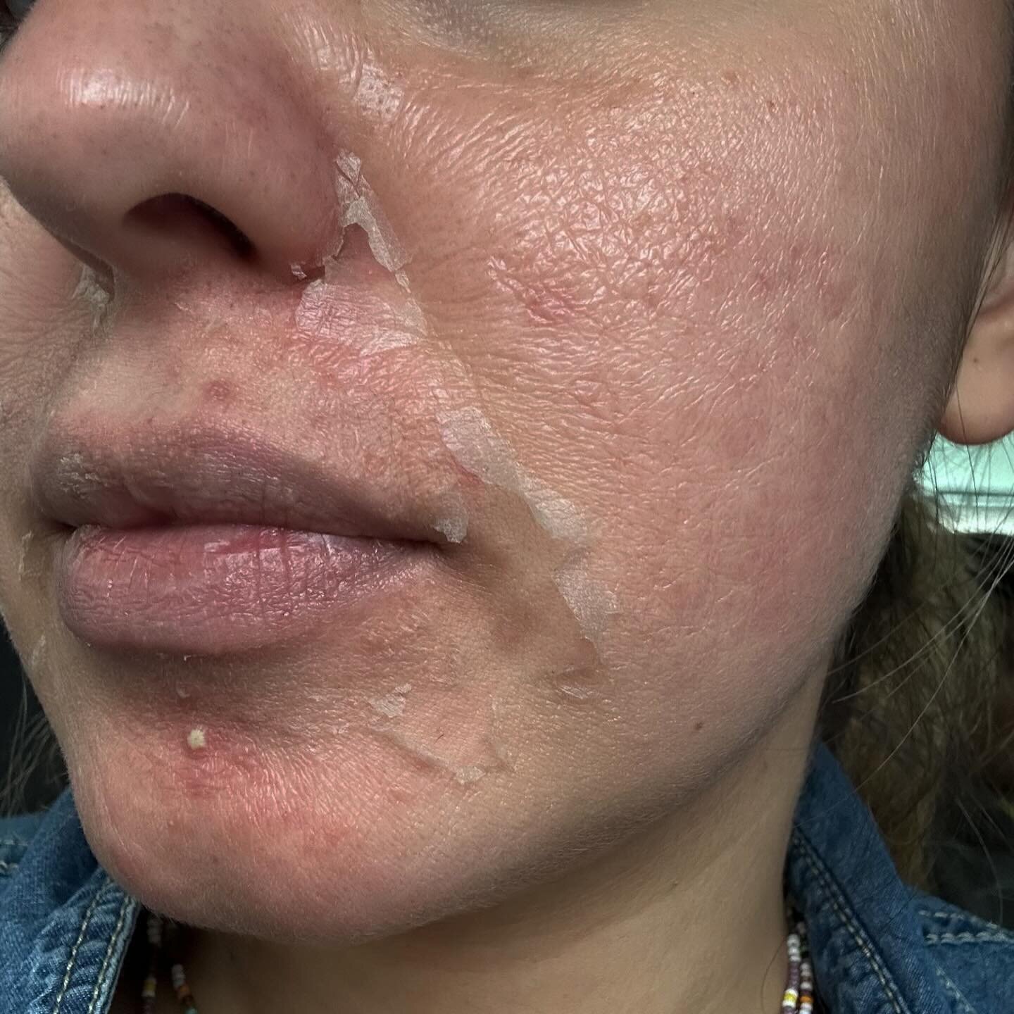 TCA chemical peel 🪄

Targets:
&bull; hyperpigmentation 
&bull; acne 
&bull; texture / scaring 

Recommended 3- 4 session for optimum results but you will see improvement with your skin after the first one! Flaking &amp; peeling depends on how many l