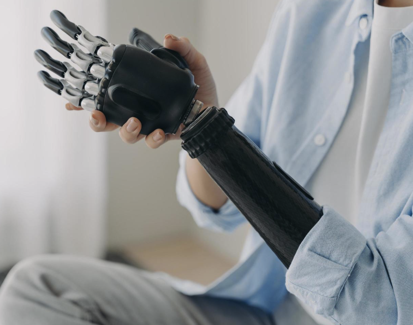 Occupational Therapy and Myoelectric Prosthetic Arms: Supporting Clients After Upper Limb Amputation