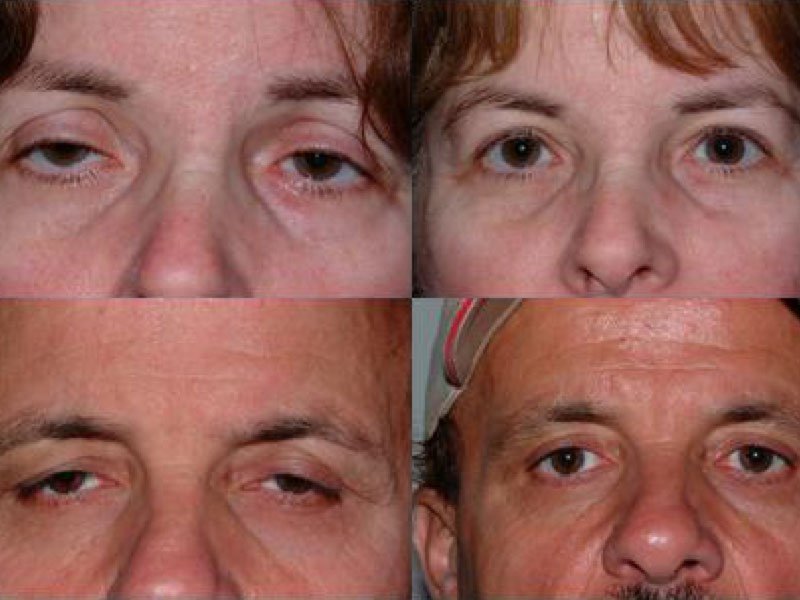 Ptosis Example
