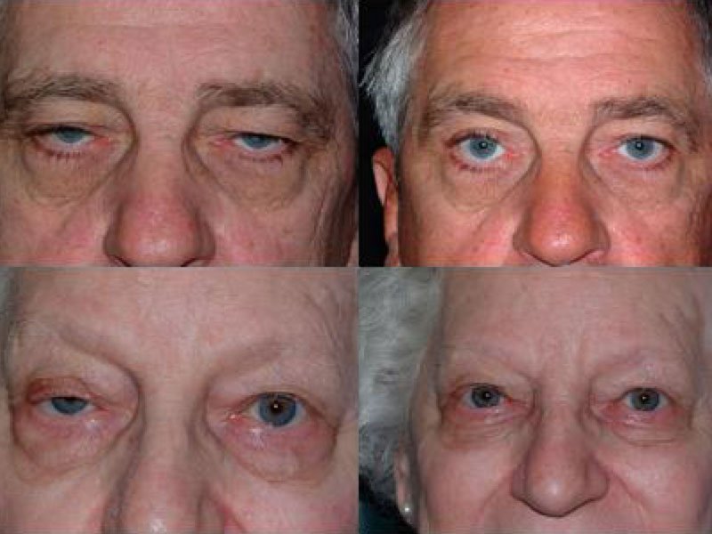 Ptosis Example