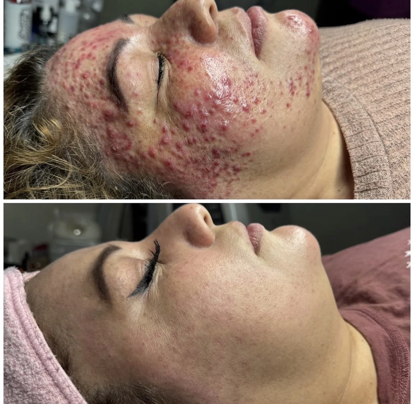 Microneedle Acne Treatment
