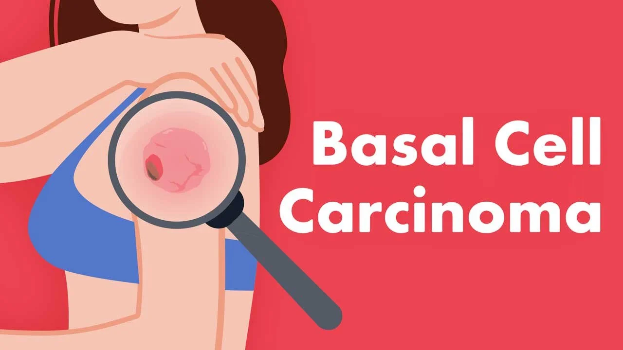 Exploring Basal Cell Carcinoma and Its Impact