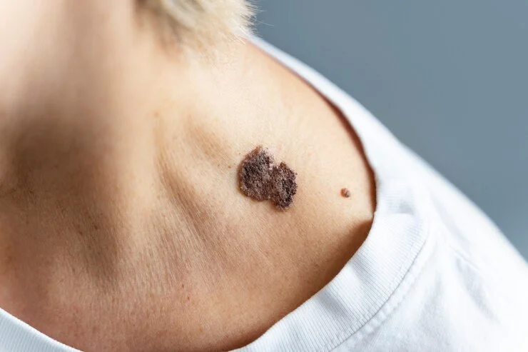 A Comprehensive Guide to Melanoma Awareness
