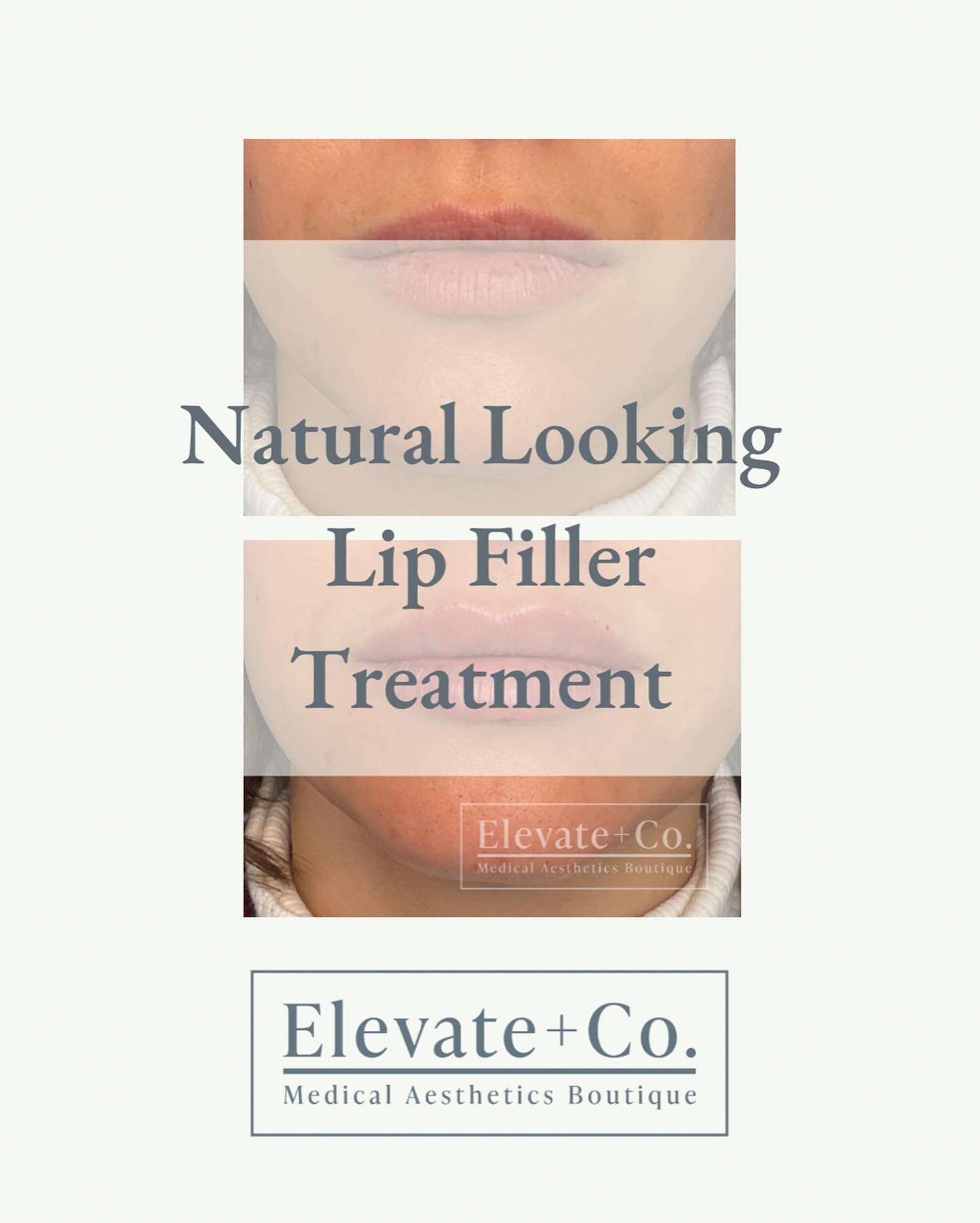 🚨PSA 8,248,219 - filler doesn&rsquo;t have to look fake and unnatural. At Elevate + Co., we tastefully put the right amount you need and select the right type of filler that will give you a beautiful and natural result. 

Interested in filler treatm