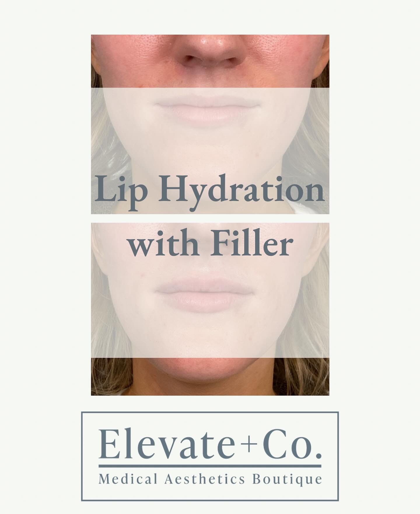 Patient: &ldquo;I don&rsquo;t want to have duck lips.&rdquo; 

Elevate + Co.: &ldquo;We got you.&rdquo;

Let&rsquo;s chat! Book your complimentary consultation conveniently through our online portal or call/text at 414-339-3499. 

&bull;&bull;&bull;&