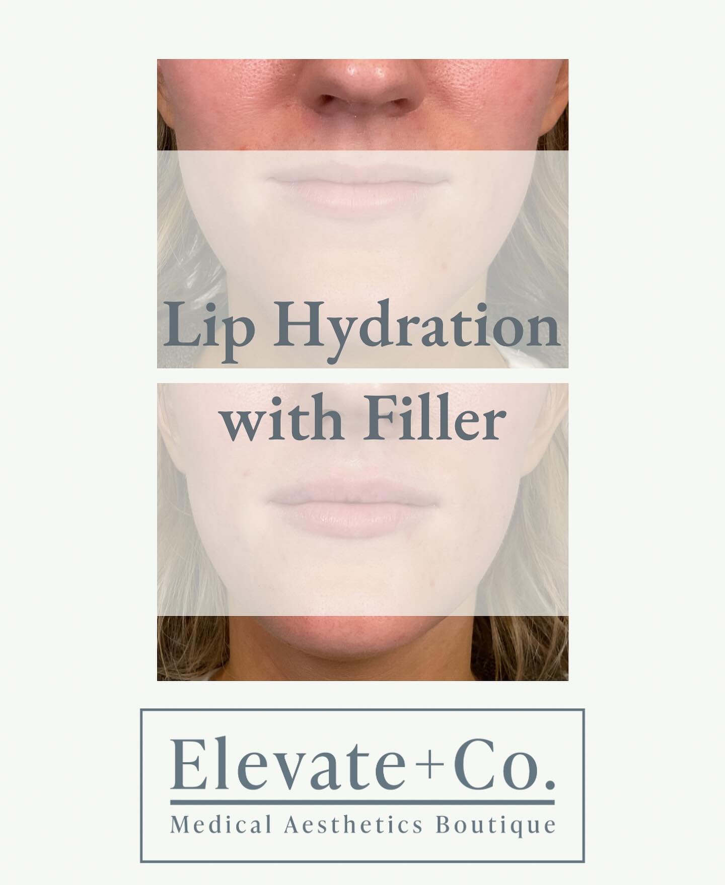 We love a little lip hydration around here. 😍

Filler treatments can look natural and subtle. Small enhancements when appropriate can still make a big impact! 

Always thankful for our patients putting their trust in us to deliver beautiful aestheti