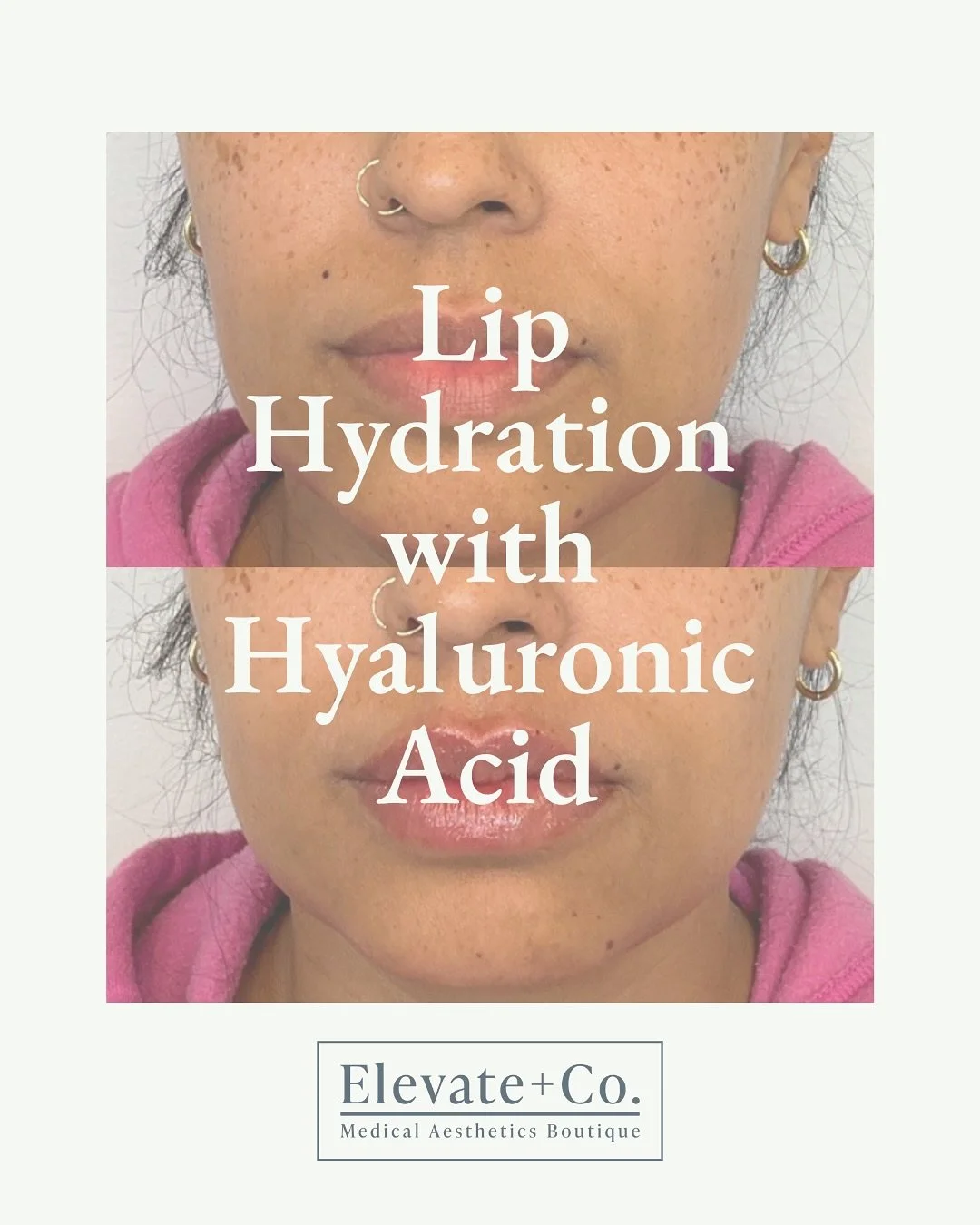 Treatments that compliment features and anatomy 🧑‍🍳💋
Our specialty is providing natural looking results for patients with injectable treatments
••••••••••
Elevate + Co. 
BOOK HERE 
💻elevatea