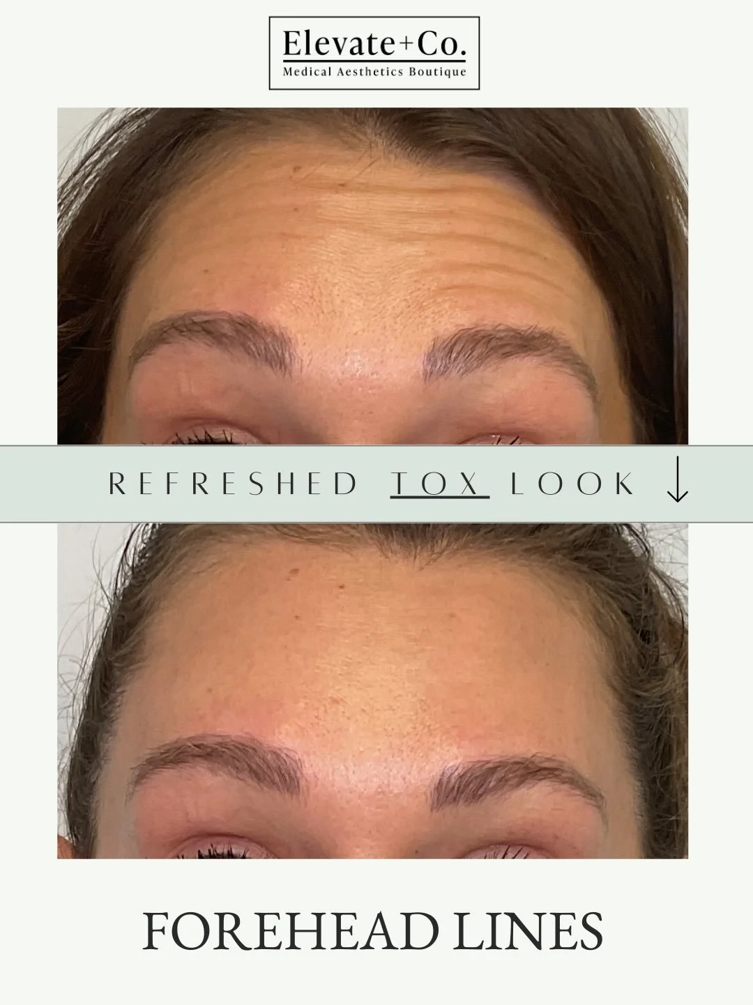 ✨ Prejuvenation: The Future of Natural-Looking Aesthetics ✨
What if the best anti-aging strategy wasn&rsquo;t correcting lines&hellip; but preventing them before they start?
Prejuvenation Botox treatments focus on softening early muscle movement that