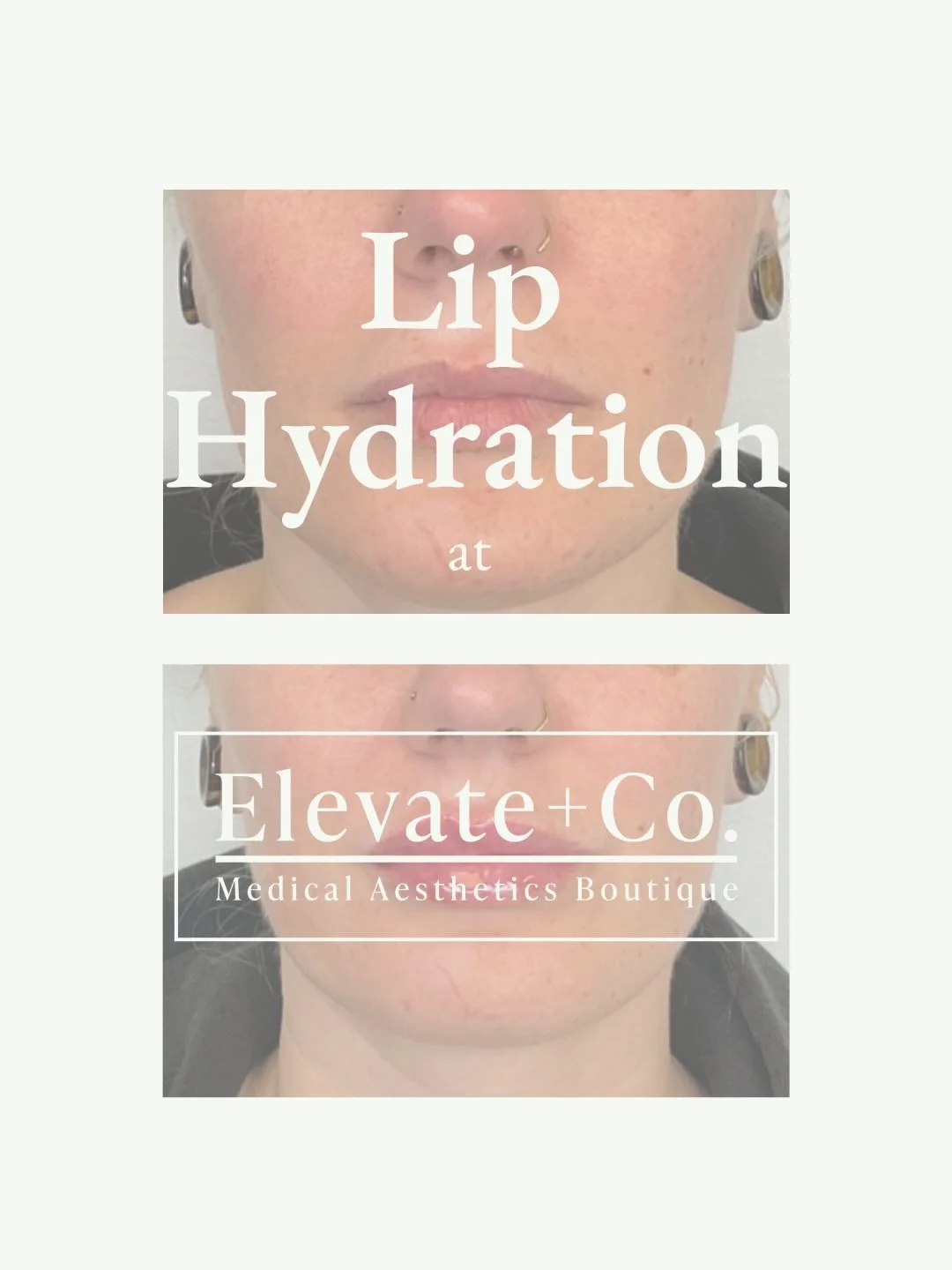 Lip filler is meant to enhance your natural lip not Not distort or make them look fake. We were able to achieve subtle hydration with this patient and create balance and symmetry between the two sides of the lips. 

Patients should never be rushed to