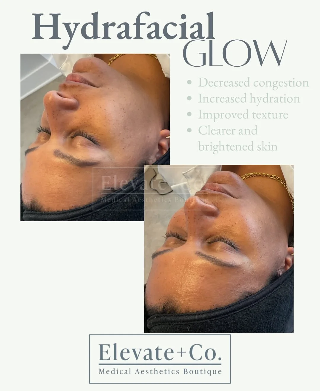 There is never a bad time for a @hydrafacial&hellip;.

&bull; Skin needs a little pick me up? = HydraFacial 
&bull; Dealing with congestion? = HydraFacial 
&bull; Big event coming up? = HydraFacial 
&bull; A day that ends in Y? = HydraFacial 

Come m