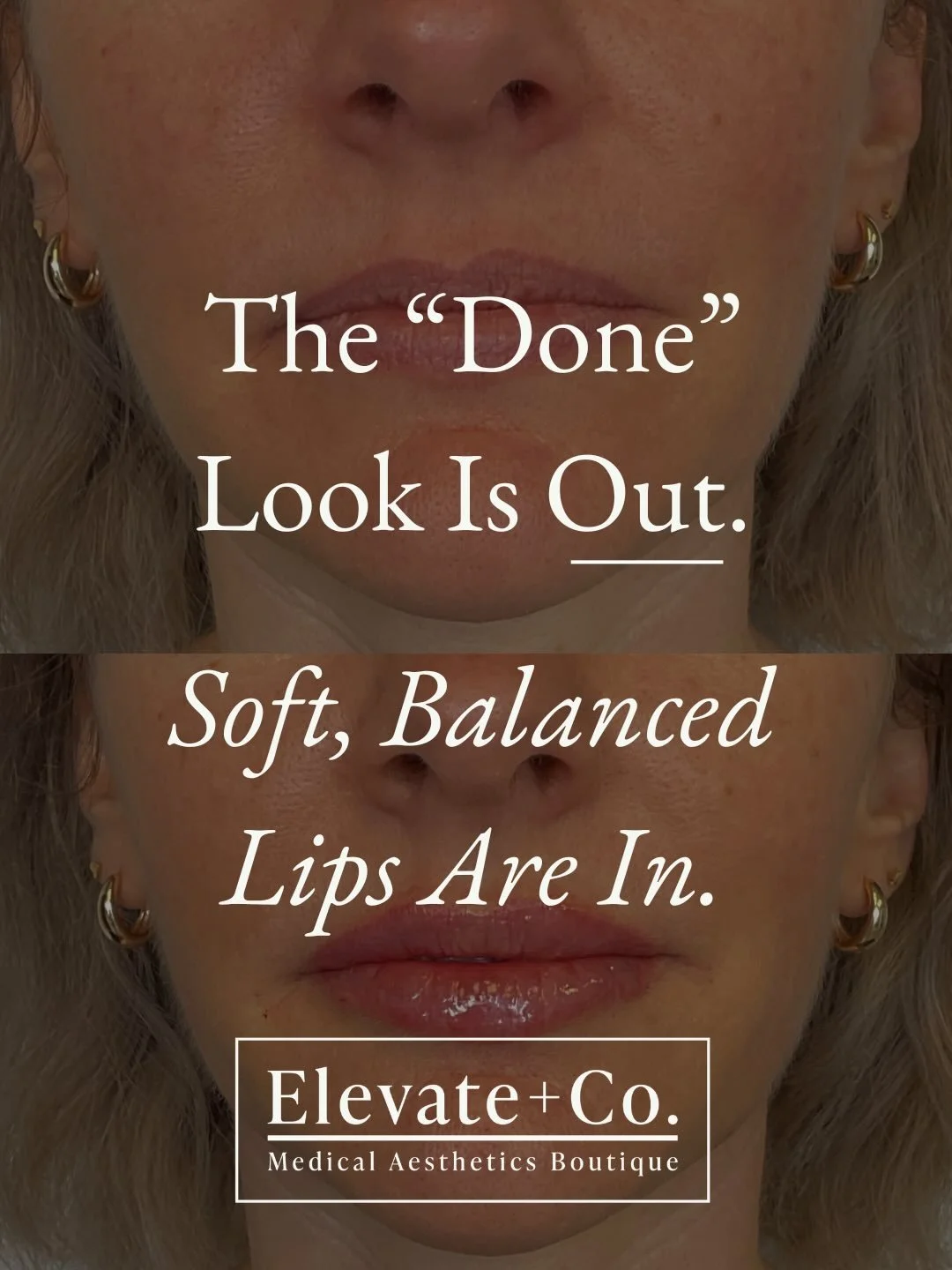 &ldquo;Lip filler is out.&rdquo;
No&mdash; just overfilled, trendy lips are out. 😬

Soft, balanced, natural-looking enhancement will always be in. 🤍

The goal isn&rsquo;t bigger lips. The goal is harmony, hydration, structure, and subtle enhancemen
