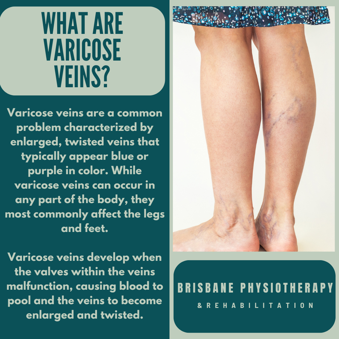 Varicose Veins Causes Symptoms Treatment Brisbane Physiotherapy Varicose Veins Causes Symptoms Treatment Brisbane Physiotherapy