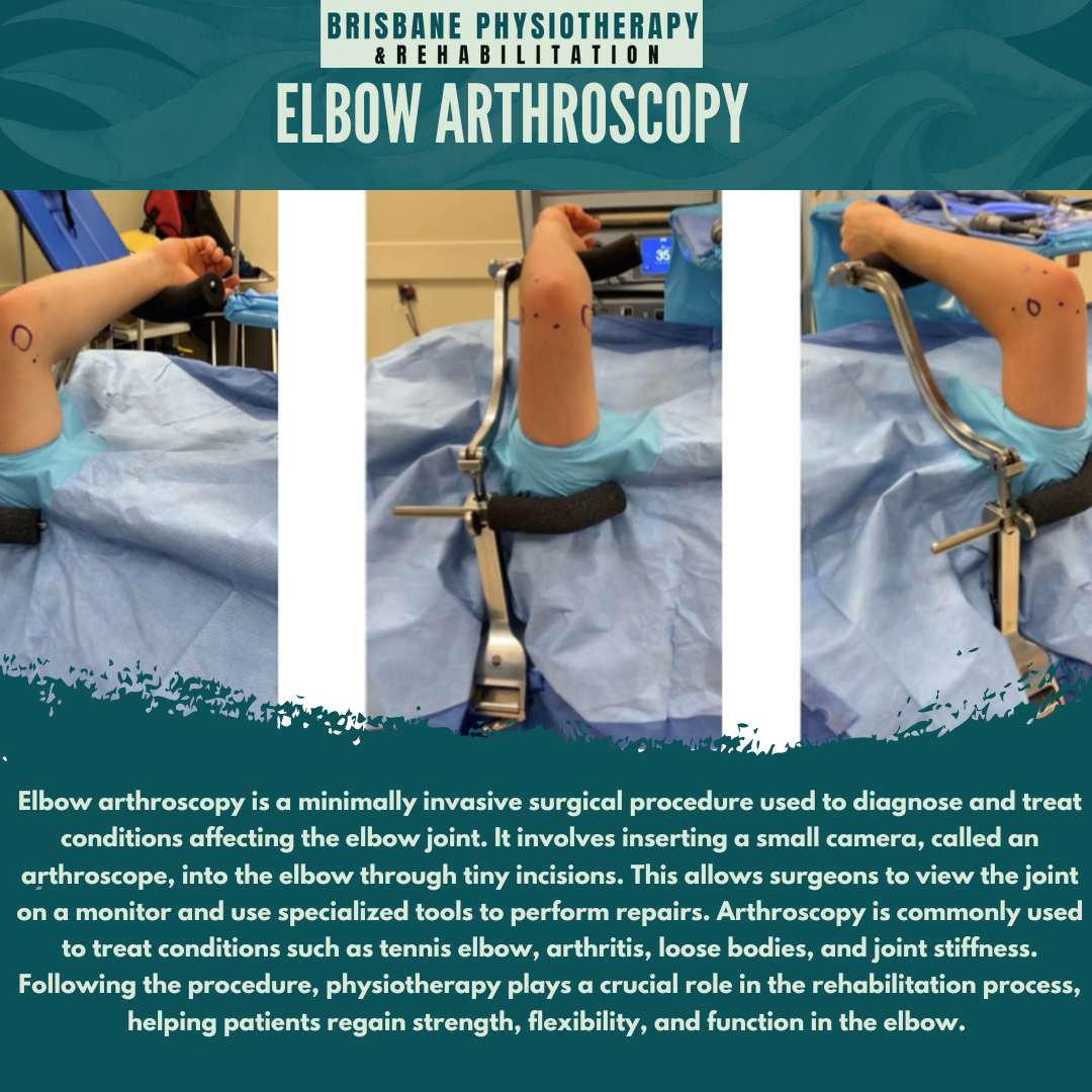 Elbow Arthroscopy: A Minimally Invasive Approach to Joint Repair and ...
